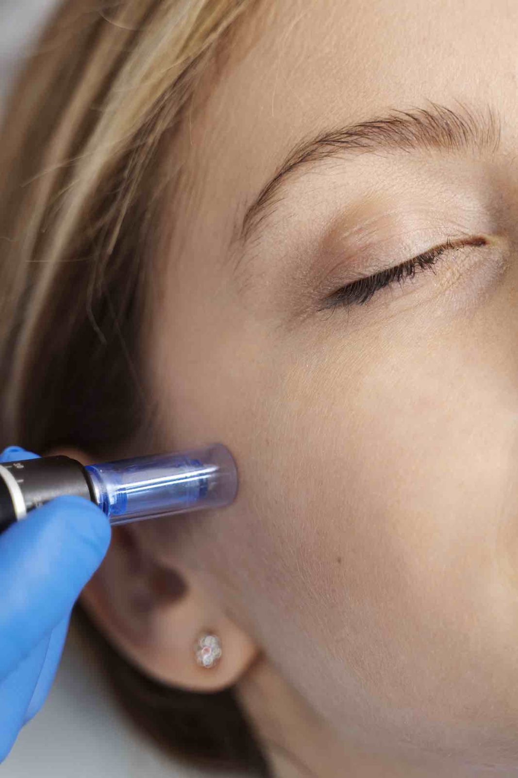 RF Microneedling treatment for skin rejuvenation